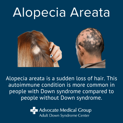 Alopecia areata