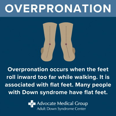 Overpronation occurs when the feet roll inward too far while walking. It is associated with flat feet. Many people with Down syndrome have flat feet.